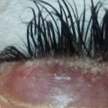 What happens when you get eyelash extensions removed?