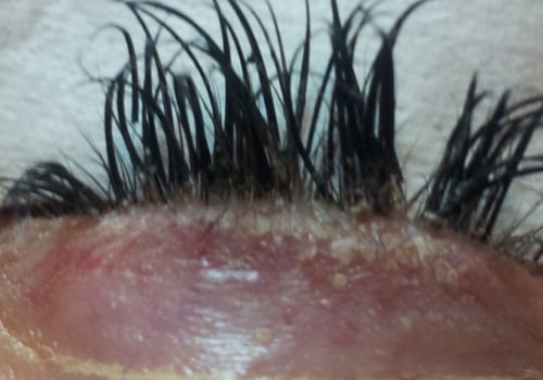 What happens when you get eyelash extensions removed?